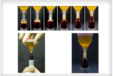 PRP or Platelet Rich Plasma Injection Gold Coast 