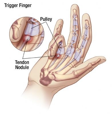 trigger finger nodule Gold Coast